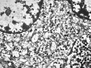 F,45y. | metastasis - carcinoid